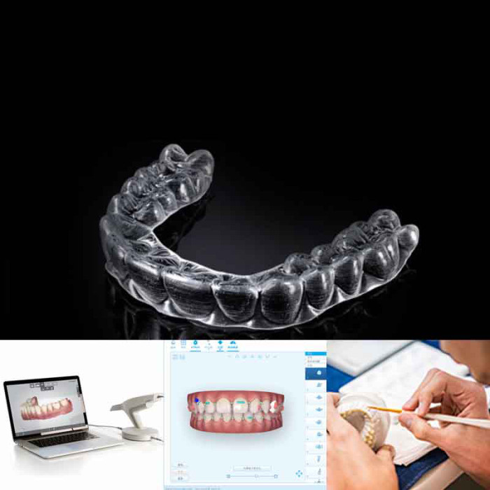Factory direct supply, online customization, Invisalign, invisible teeth correction braces (treatment course: 1 month)