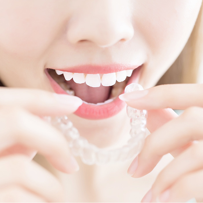 Factory direct supply, online customization, Invisalign, invisible teeth correction braces (treatment duration: 24 months)